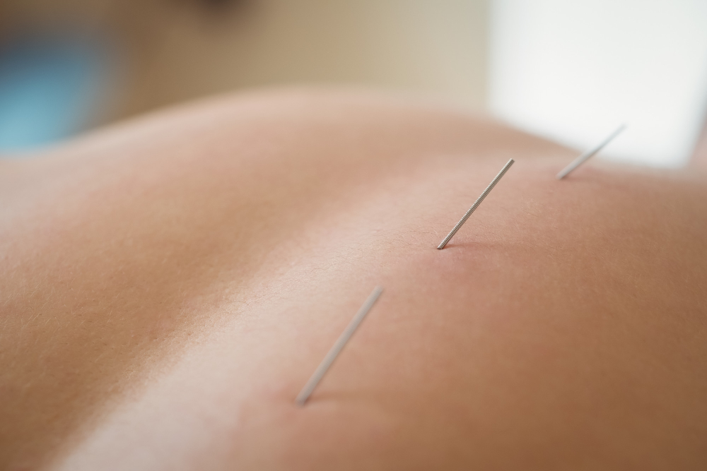 Menopause Acupuncture in Northbrook, IL
