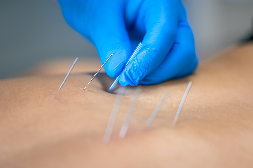 Exploring Menstrual and Hormonal Balance Through Acupuncture in Northbrook, IL