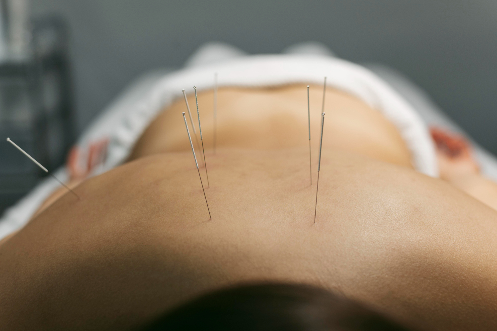 Fertility Acupuncture in Chicago A Natural Approach to Boosting Conception
