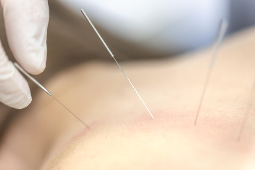 Is Acupuncture Safe During Pregnancy in Chicago? Benefits by Trimester