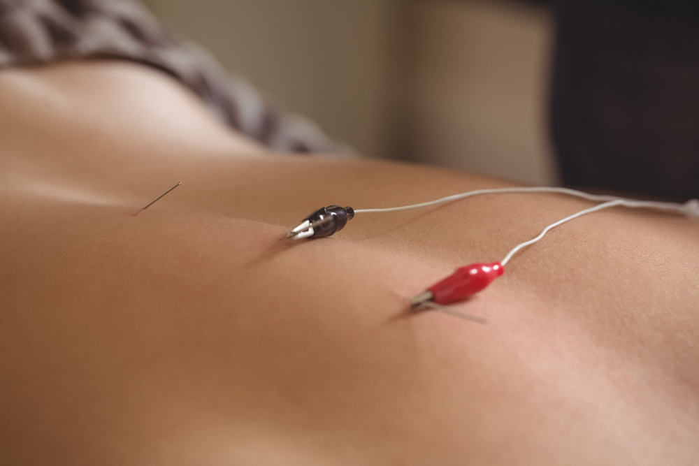 Acupuncture for Irregular Periods in Northbrook  Acupuncture & Wellness Center Chicago