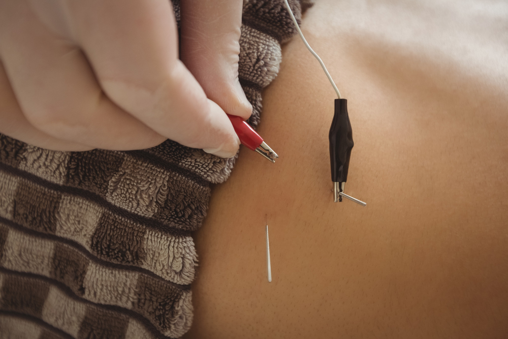 Can Acupuncture Help With Irregular Periods? What Northbrook Women Should Know