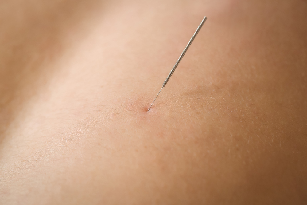Acupuncture for Painful Periods in Northbrook, IL  Acupuncture & Wellness Center Chicago