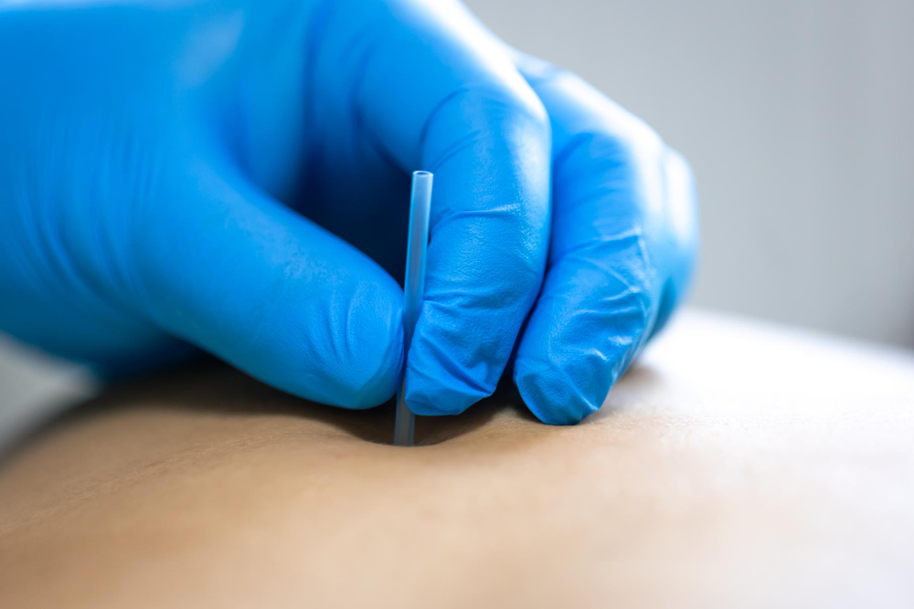 Can Acupuncture Help With Hormone Imbalance? A Women’s Health Acupuncture Guide in Chicago, IL